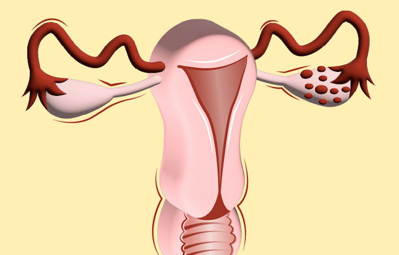 Things To Know About Polycystic Ovary Syndrome