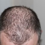 Scientists discover the genetic cause of male baldness