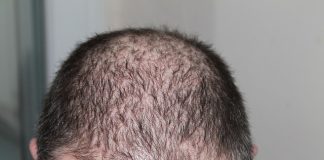 Scientists discover the genetic cause of male baldness