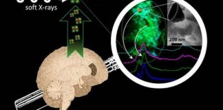 Metals in the brain drive Alzheimer’s disease