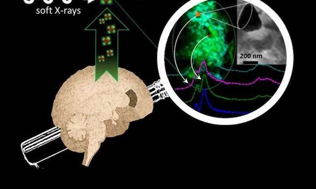 Metals in the brain drive Alzheimer’s disease