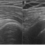 Shoulder 'brightness' on ultrasound could be a sign of diabetes