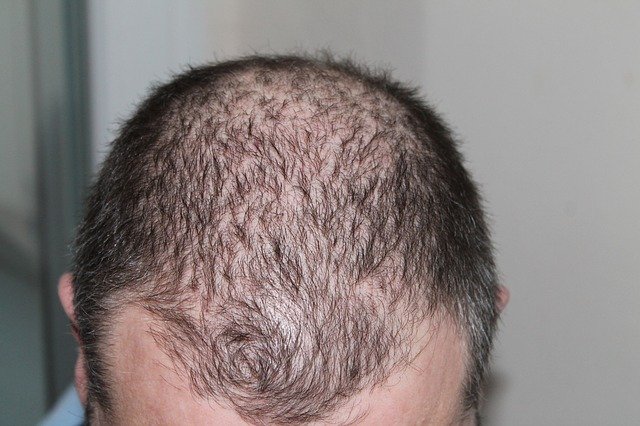 3 common ways to beat hair loss