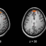 Scientists discover 104 high-risk genes for schizophrenia