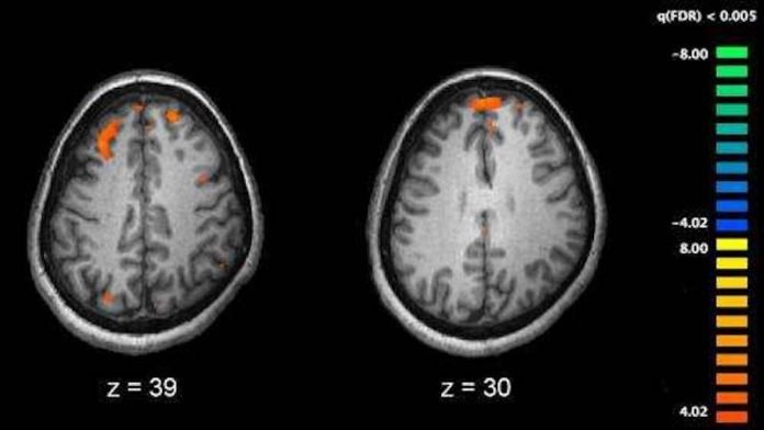 Scientists discover 104 high-risk genes for schizophrenia