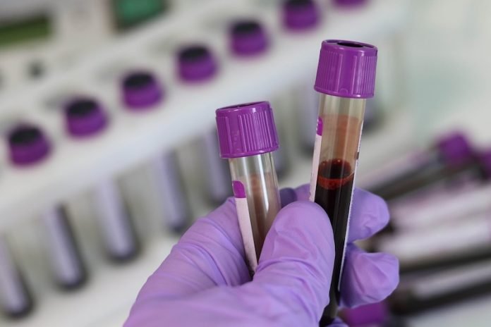 This simple blood test may predict heart attack and stroke