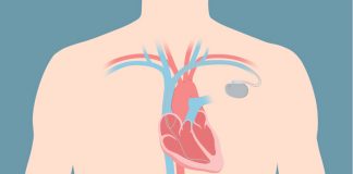 5 tips to prevent anxiety if you use implanted heart device