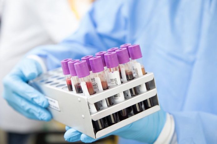 Lower level of this stuff in blood linked to higher COVID-19 death risk