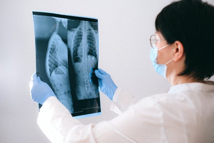 New finding explains severe COVID-19 attacks on the lungs
