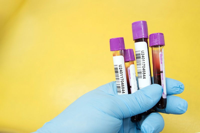 This Blood Test Can Predict Dementia, Alzheimer's 5 Years Early