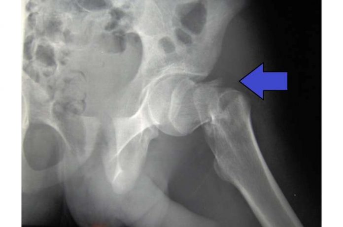 The death risk from hip fracture is lower now, study finds