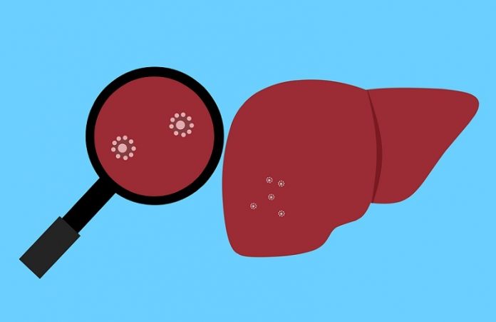 Nonalcoholic fatty liver disease- What you need to know