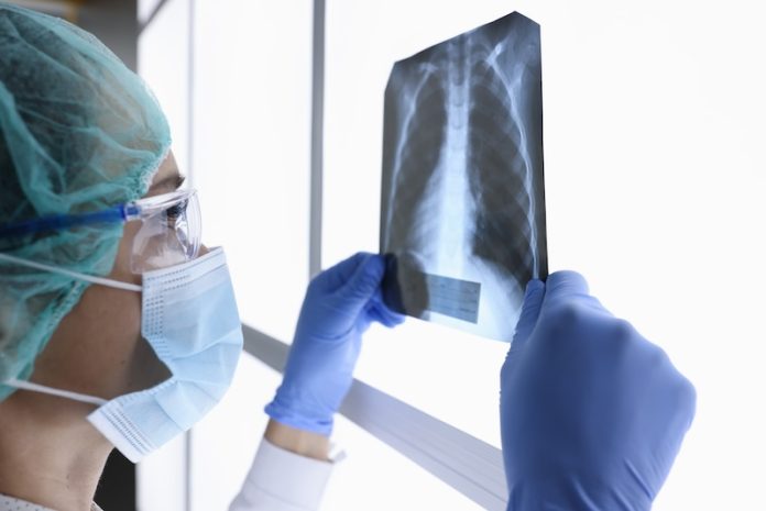 Fatty liver disease could harm your lung function