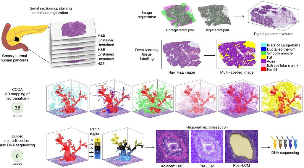 New 3d technique uncovers early signs of pancreatic cancer