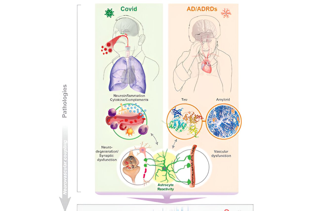 Study Finds Alzheimer's-like Brain Changes In Long COVID Patients