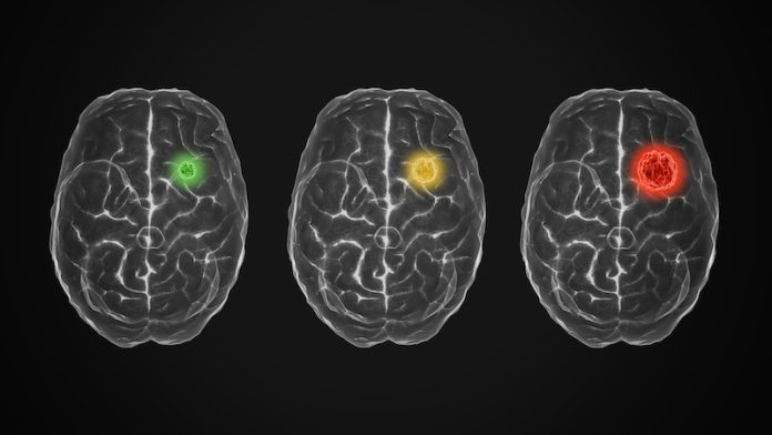 0-Scientists discover a surprising cause of stroke