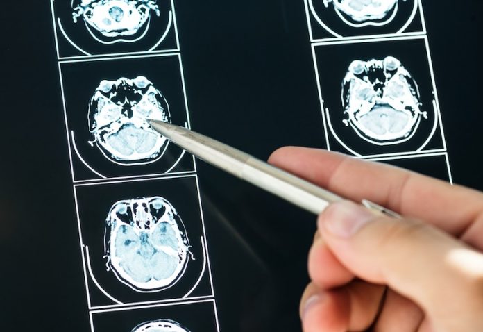 Ischemic stroke
