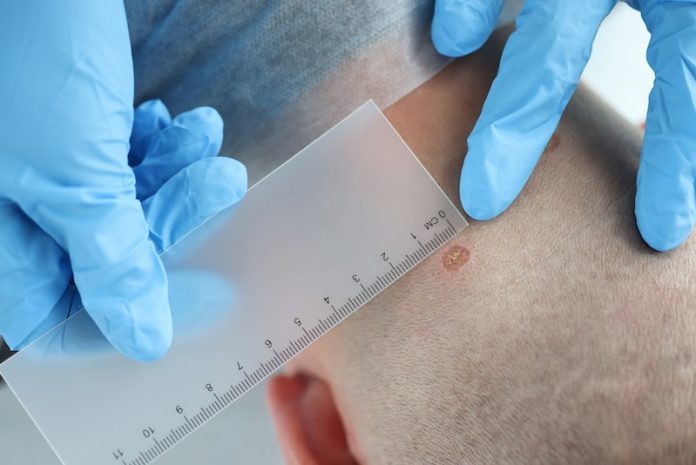 Maintaining vitamin D levels may boost immunotherapy response in skin cancer patients
