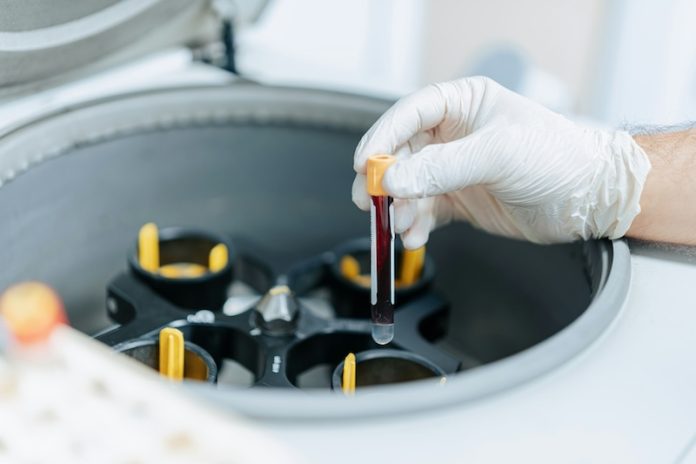 New blood test shows Alzheimer