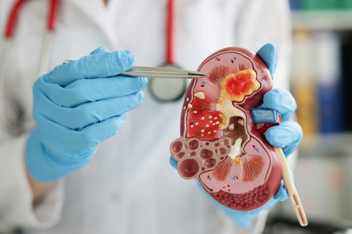 Best_Foods_to_Prevent_Kidney_Stones