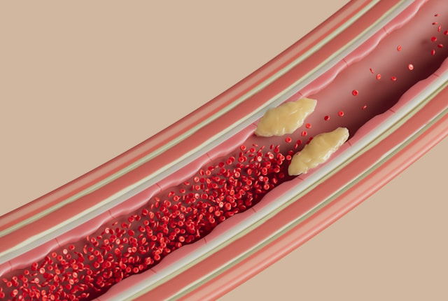 Blood_Clots_and_Genes_Sweden