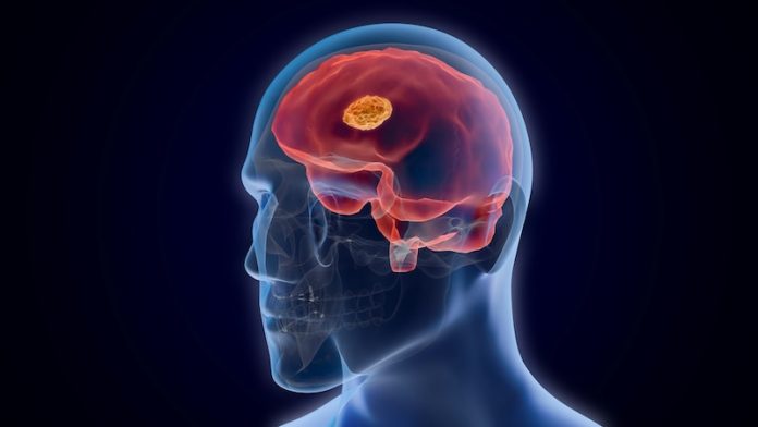 Iron buildup in the brain may speed up Alzheimer