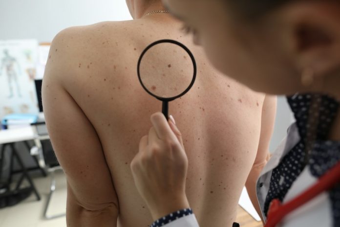 Study finds new way to feed skin cancer