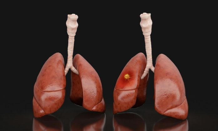 Aging_and_Lung_Cancer_Study