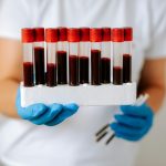 Simple blood test spot liver cancer risk early—even without hepatitis or cirrhosis