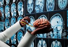 New AI tool can detect stroke and brain cancer faster